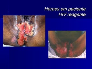 Herpes em paciente
      HIV reagente
 