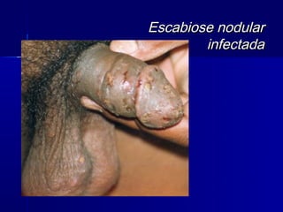 Escabiose nodular
        infectada
 