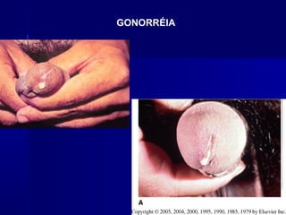 GONORRÉIA
 