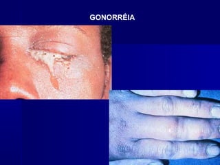 GONORRÉIA
 