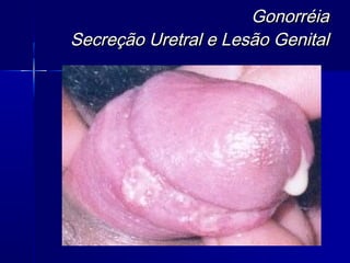 Gonorréia
Secreção Uretral e Lesão Genital
 
