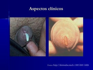 Aspectos clínicos




         Fontes: http://dermatlas.med   e CRT-DST-AIDS
 