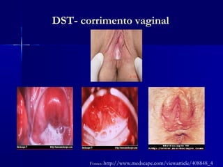 DST- corrimento vaginal




       Fontes: http://www.medscape.com/viewarticle/408848_4
 