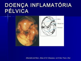 DOENÇA INFLAMATÓRIA
PÉLVICA




      (Mandell and Rein, Atlas of Inf. Diseases, vol 5 Sex Trans Dis)
 