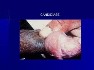 CANDIDÍASE
 
