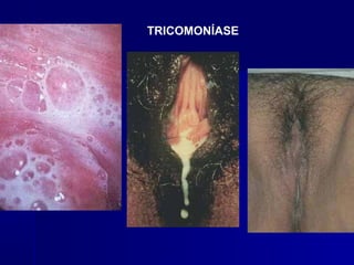 TRICOMONÍASE
 