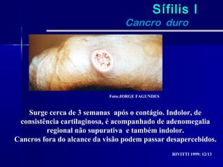Sífilis I
                                  Cancro duro




                            Foto:JORGE FAGUNDES


   Surge cerca de 3 semanas após o contágio. Indolor, de
 consistência cartilaginosa, é acompanhado de adenomegalia
         regional não supurativa e também indolor.
Cancros fora do alcance da visão podem passar desapercebidos.
                                                  RIVITTI 1999: 12/13
 