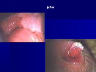HPV
 