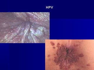 HPV
 
