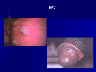 HPV
 
