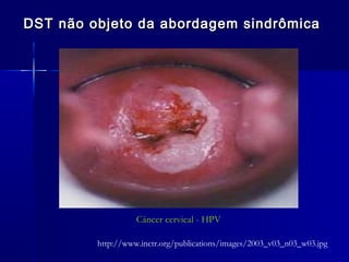 DST não objeto da abordagem sindrômica




                   Câncer cervical - HPV

         http://www.inctr.org/publications/images/2003_v03_n03_w03.jpg
 