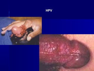 HPV
 