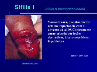 Sífilis I                Sífilis & Imunodeficiência


                          Variante rara, que atualmente
                          retoma importância com o
                          advento da AIDS.Clinicamente
                          caracterizada por lesões
                          destrutivas, úlcero-necróticas,
                          fagedênicas.



                                          RIVITTI 1999: 16/17



   FOTO JORGE FAGUNDES
 