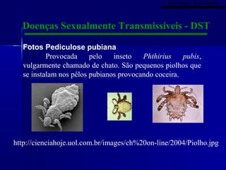 Mariel Hidalgo - Porto Alegre/RS
                                                  Mariel Hidalgo - Porto Alegre/RS




  Doenças Sexualmente Transmissíveis - DST

   Fotos Pediculose pubiana
           Provocada     pelo   inseto   Phthirius    pubis,
   vulgarmente chamado de chato. São pequenos piolhos que
   se instalam nos pêlos pubianos provocando coceira.




http://cienciahoje.uol.com.br/images/ch%20on-line/2004/Piolho.jpg
 