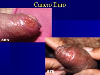 Cancro Duro
 