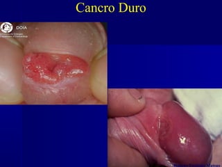 Cancro Duro




PE -CRT DST/AIDS                 Rubens Yoshiaki Matsuo
 