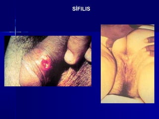 SÍFILIS
 