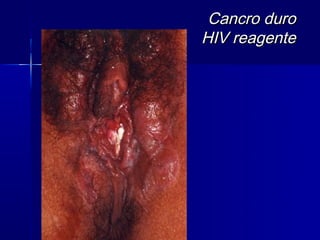 Cancro duro
HIV reagente
 