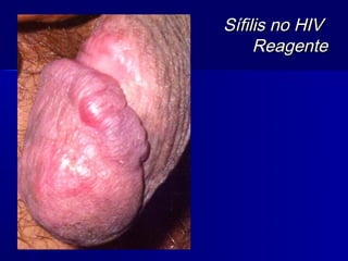 Sífilis no HIV
     Reagente
 