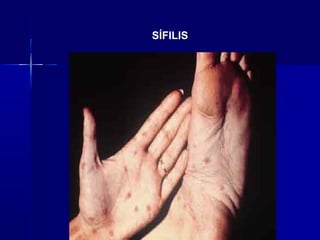 SÍFILIS
 