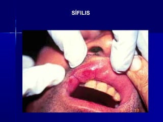 SÍFILIS
 