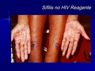 Sífilis no HIV Reagente
 
