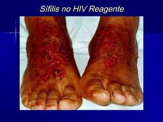 Sífilis no HIV Reagente
 
