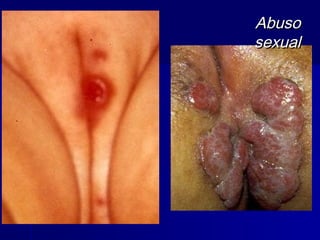 Abuso
sexual
 