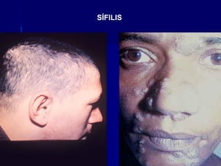 SÍFILIS
 