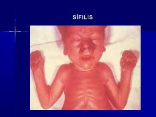SÍFILIS
 