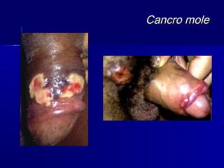 Cancro mole
 