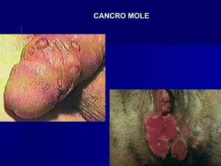 CANCRO MOLE
 