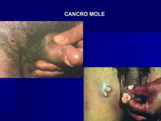 CANCRO MOLE
 
