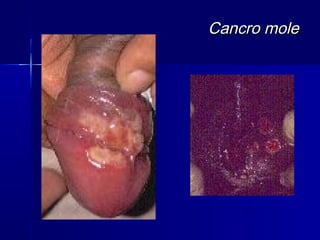 Cancro mole
 