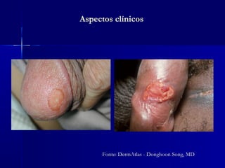 Aspectos clínicos




      Fonte: DermAtlas - Donghoon Song, MD
 