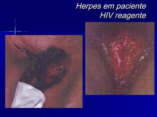 Herpes em paciente
      HIV reagente
 
