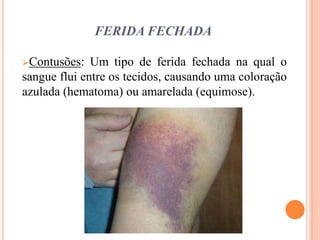 FERIDA FECHADA
Contusões: Um tipo de ferida fechada na qual o
sangue flui entre os tecidos, causando uma coloração
azulada (hematoma) ou amarelada (equimose).
 