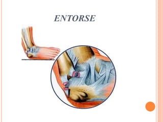 ENTORSE
 