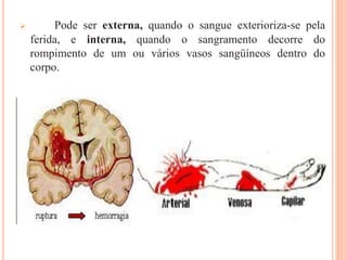  Pode ser externa, quando o sangue exterioriza-se pela
ferida, e interna, quando o sangramento decorre do
rompimento de um ou vários vasos sangüíneos dentro do
corpo.
 