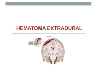 HEMATOMA EXTRADURAL
 