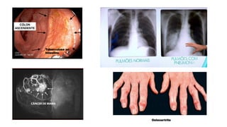 Tuberculose no
intestino
Osteoartrite
 