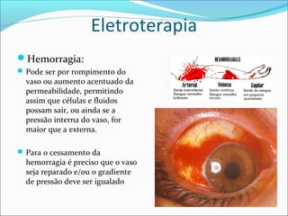 Eletroterapia
Hemorragia:
Pode ser por rompimento do
vaso ou aumento acentuado da
permeabilidade, permitindo
assim que células e fluidos
possam sair, ou ainda se a
pressão interna do vaso, for
maior que a externa.
Para o cessamento da
hemorragia é preciso que o vaso
seja reparado e/ou o gradiente
de pressão deve ser igualado
 