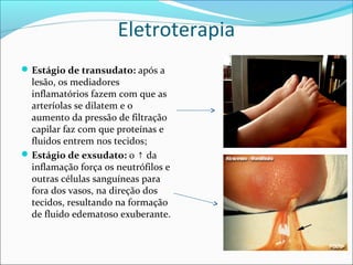 Eletroterapia
Estágio de transudato: após a
lesão, os mediadores
inflamatórios fazem com que as
arteríolas se dilatem e o
aumento da pressão de filtração
capilar faz com que proteínas e
fluidos entrem nos tecidos;
Estágio de exsudato: o da↑
inflamação força os neutrófilos e
outras células sanguíneas para
fora dos vasos, na direção dos
tecidos, resultando na formação
de fluido edematoso exuberante.
 