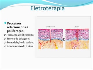 Eletroterapia
Processos
relacionados à
poliferação:
1º Formação de fibroblasto;
2º Síntese de colágeno;
3º Remodelação do tecido;
4º Alinhamento do tecido.
 