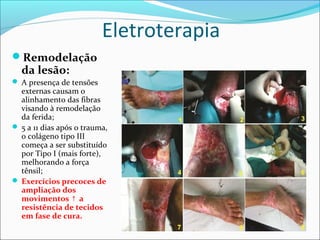 Eletroterapia
Remodelação
da lesão:
 A presença de tensões
externas causam o
alinhamento das fibras
visando à remodelação
da ferida;
 5 a 11 dias após o trauma,
o colágeno tipo III
começa a ser substituído
por Tipo I (mais forte),
melhorando a força
tênsil;
 Exercícios precoces de
ampliação dos
movimentos a↑
resistência de tecidos
em fase de cura.
 