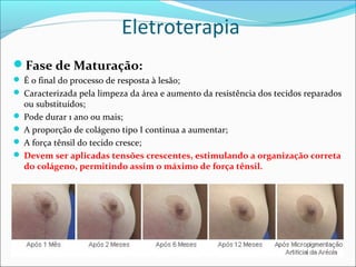 Eletroterapia
Fase de Maturação:
 É o final do processo de resposta à lesão;
 Caracterizada pela limpeza da área e aumento da resistência dos tecidos reparados
ou substituídos;
 Pode durar 1 ano ou mais;
 A proporção de colágeno tipo I continua a aumentar;
 A força tênsil do tecido cresce;
 Devem ser aplicadas tensões crescentes, estimulando a organização correta
do colágeno, permitindo assim o máximo de força tênsil.
 