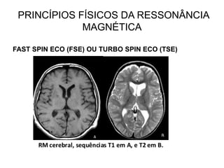 PRINCÍPIOS FÍSICOS DA RESSONÂNCIA
MAGNÉTICA
FAST SPIN ECO (FSE) OU TURBO SPIN ECO (TSE)
 