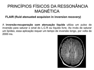 PRINCÍPIOS FÍSICOS DA RESSONÂNCIA
MAGNÉTICA
FLAIR (fluid atenuated acquision in inversion recovery)
A inversão-recuperação com atenuação líquida utiliza um pulso de
inversão para saturar o sinal do L.C.R ou líquido livre. Ao invés de saturar
um lipídeo, essa aplicação requer um tempo de inversão longo, por volta de
2000 ms.
 