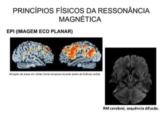 PRINCÍPIOS FÍSICOS DA RESSONÂNCIA
MAGNÉTICA
EPI (IMAGEM ECO PLANAR)
 
