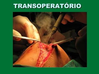 TRANSOPERATÓRIOTRANSOPERATÓRIO
 